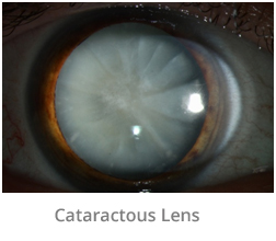 cataractous-lens