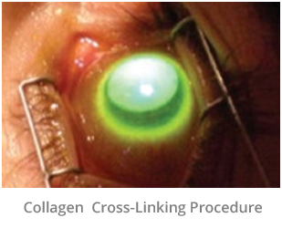 collagen-cross-linking-procedure