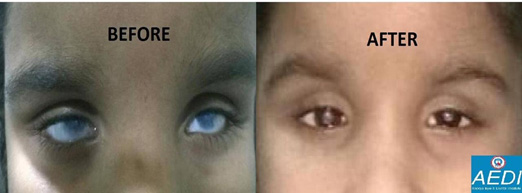 contact-lens-before-after
