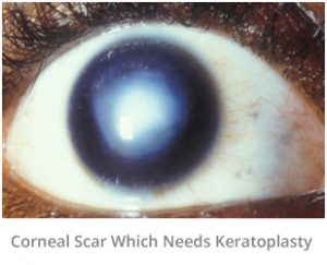 corneal-scar-which-needs-keratoplasty