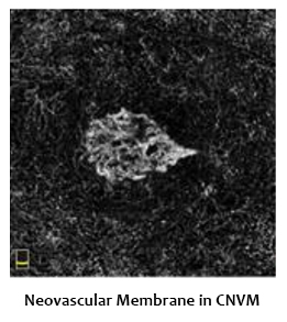 neovascular-membrane-CNVM
