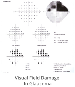 visual-field-damage-in-glaucoma